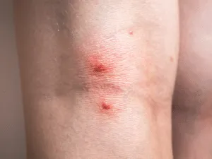 Punture di scleroderma domesticum